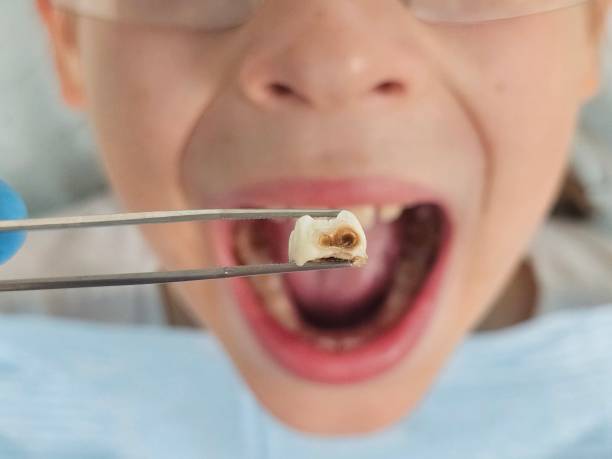 Best Emergency Dental Care for Broken or Chipped Teeth in Svis, IL
